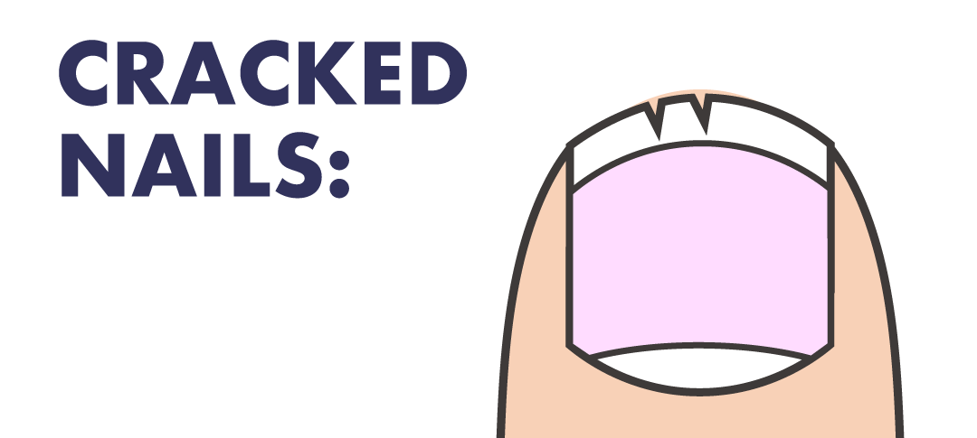 爪　縦割れ　原因